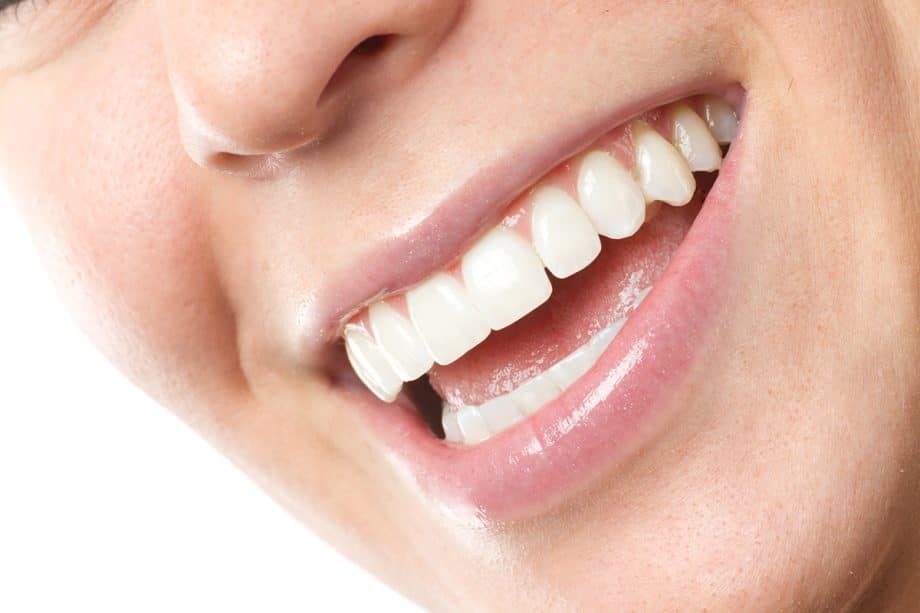 Are Dental Veneers Worth It?