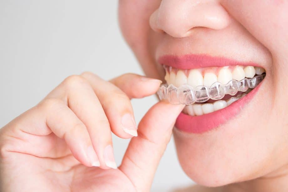 Could I Be A Candidate For Invisalign?