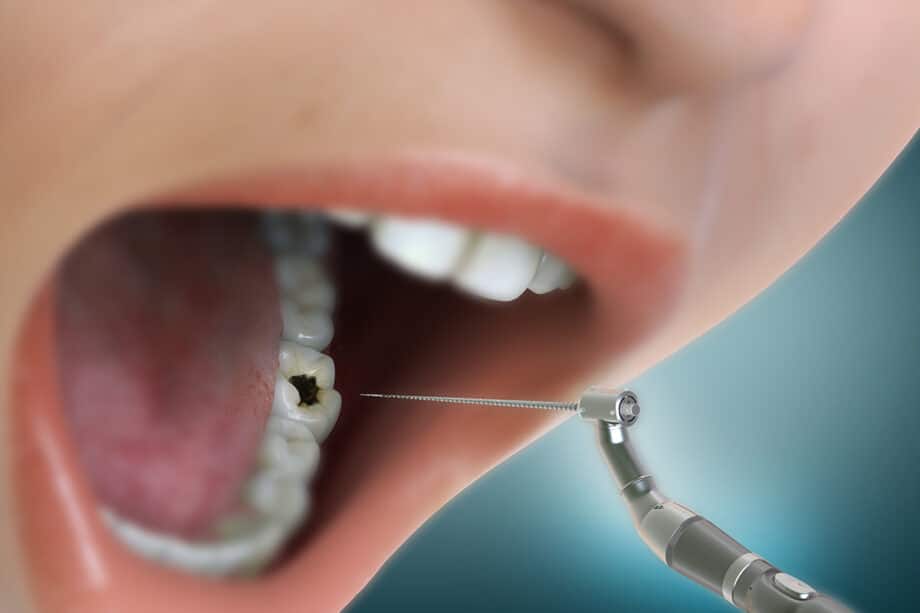 Does a Root Canal Hurt? Separating Myth from Reality