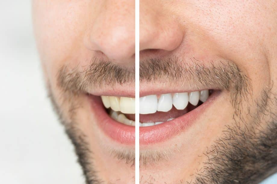 How Does Teeth Whitening Work in a Dental Office?