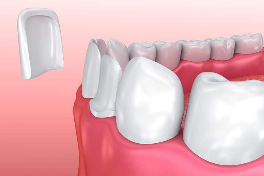 How Long Do Dental Veneers Last?