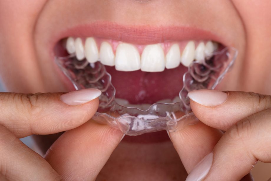 a mouth with an Invisalign tray