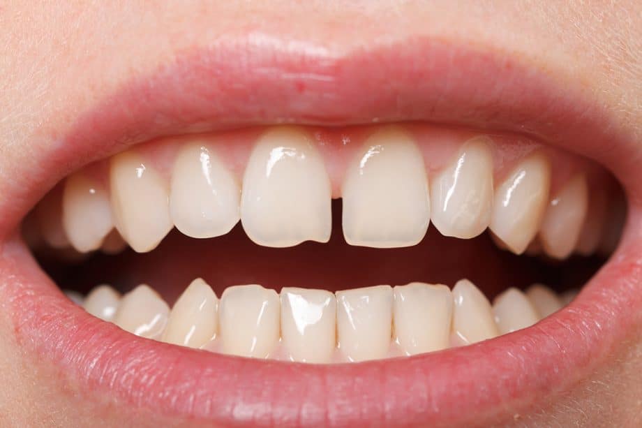 How to Fix Small Gaps Between Teeth Without Braces