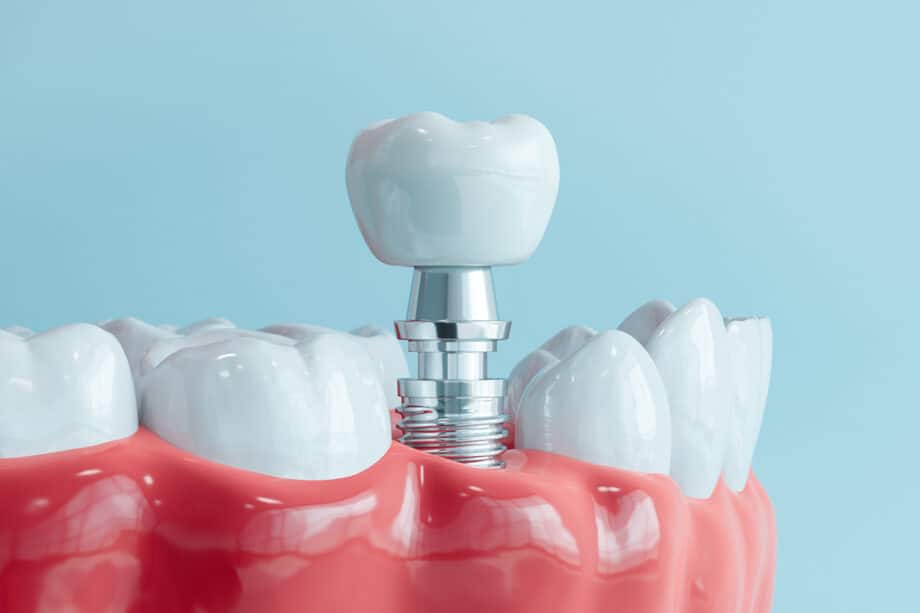 What Disqualifies You from Getting Dental Implants?
