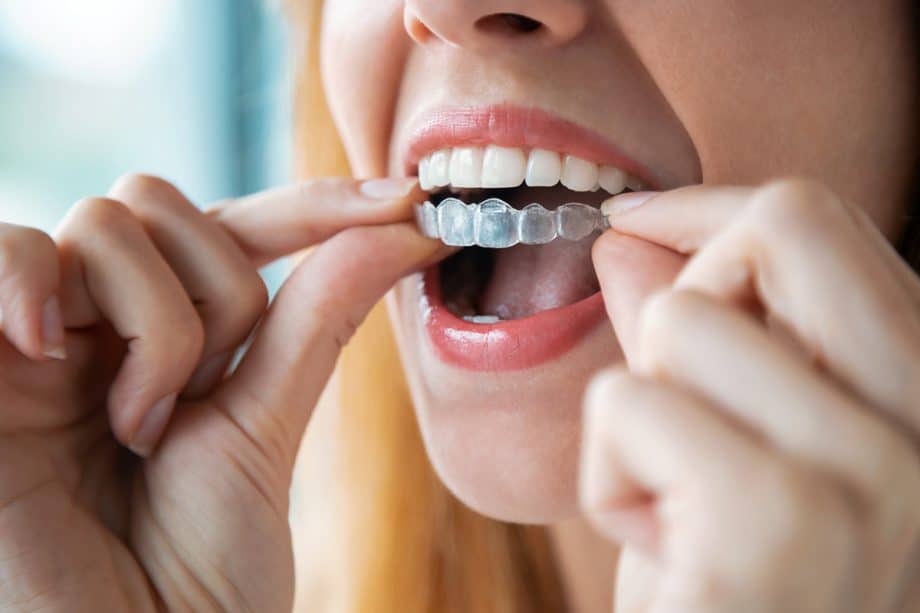 What Exactly Is Invisalign, and How Does It Work?